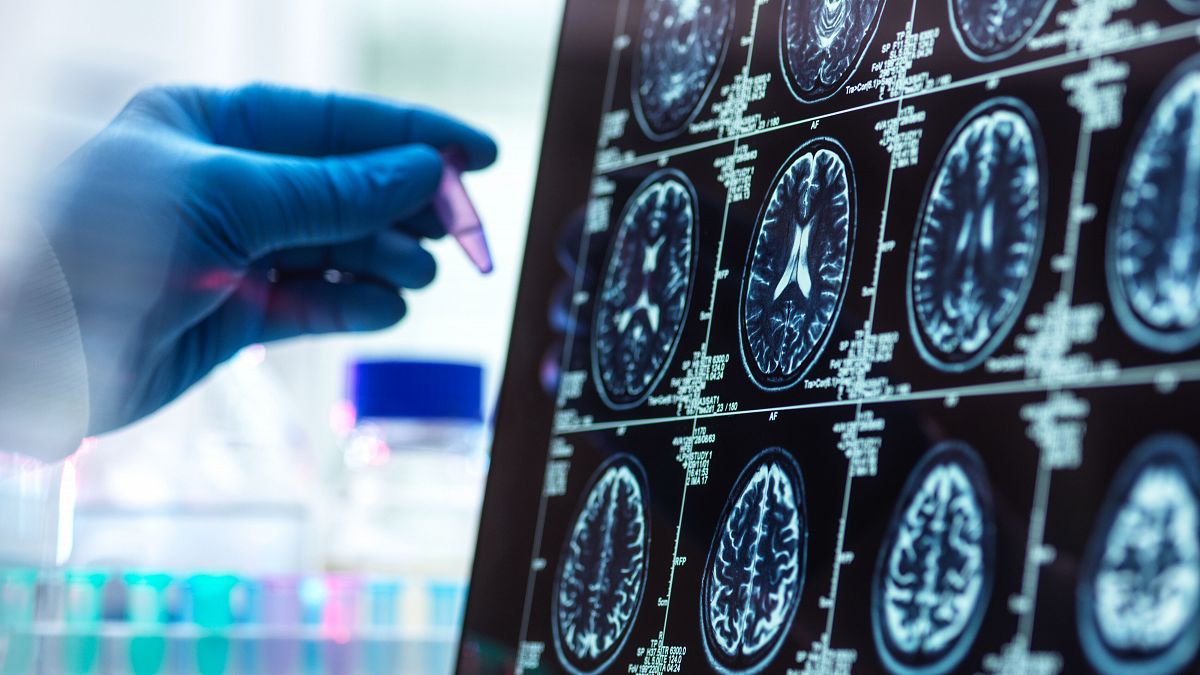 Nueva técnica permite ver oligómeros de parkinson en el cerebro humano
